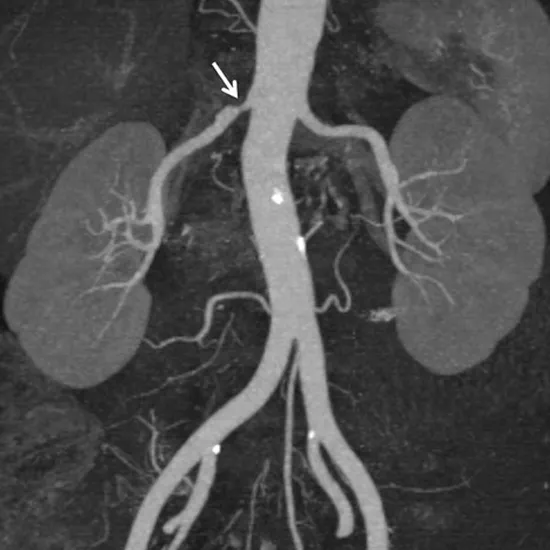 MR Angiography For Renal Vessels